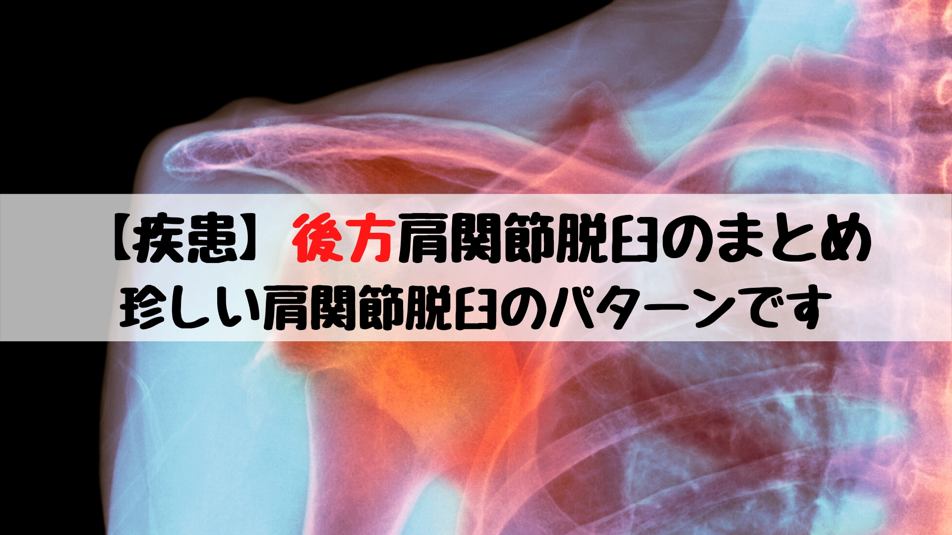 疾患】後方肩関節脱臼のまとめ【随時更新中】|踊る救急医 疾患】後方肩関節脱臼のまとめ【随時更新中】|踊る救急医