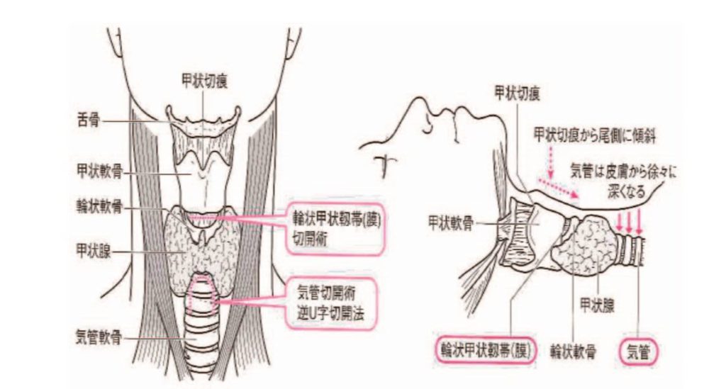 気管切開でも話せますか？