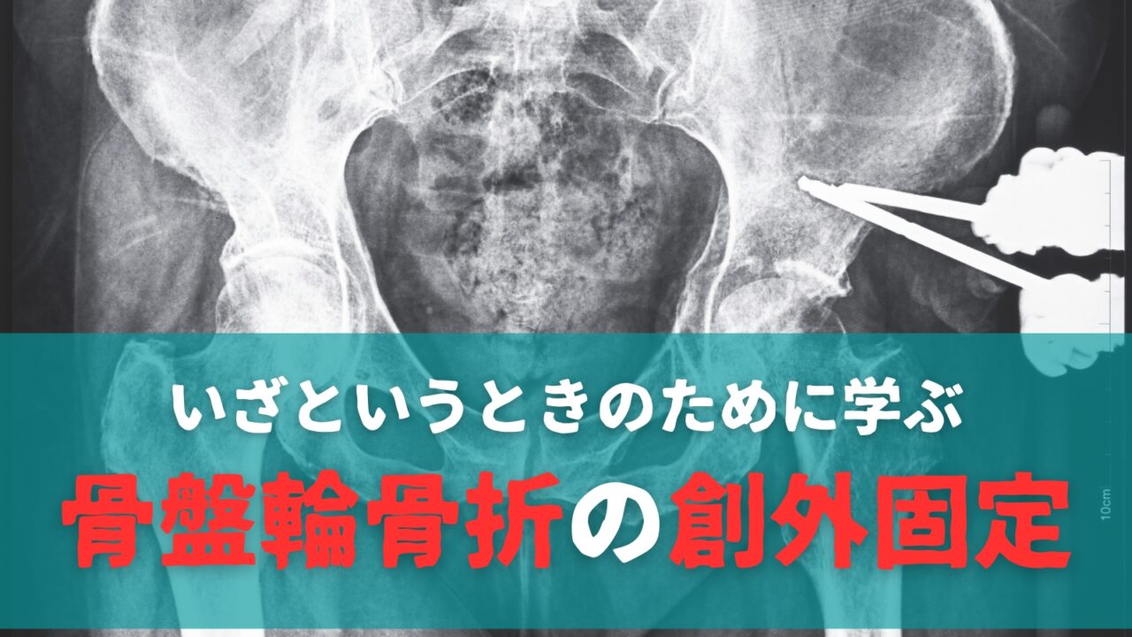 【いざというときのために学ぶ】骨盤輪骨折の創外固定|踊る救急医