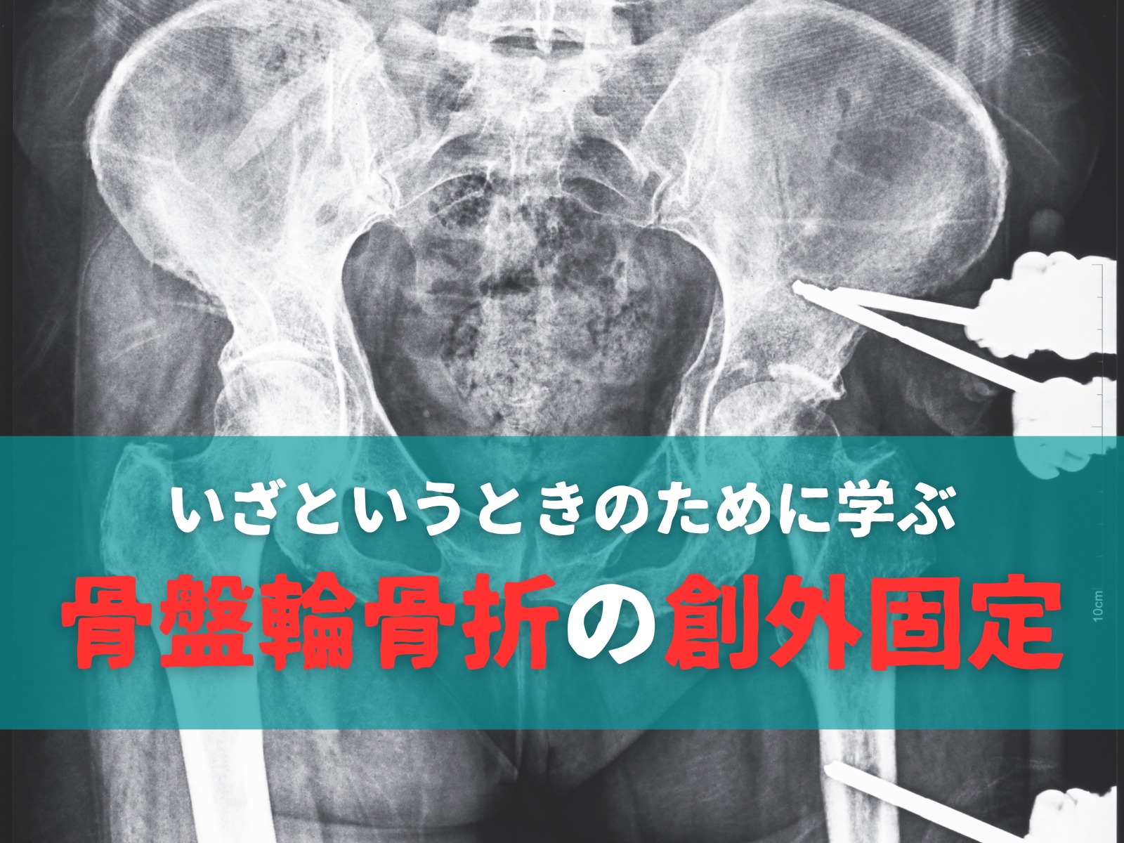 【いざというときのために学ぶ】骨盤輪骨折の創外固定|踊る救急医